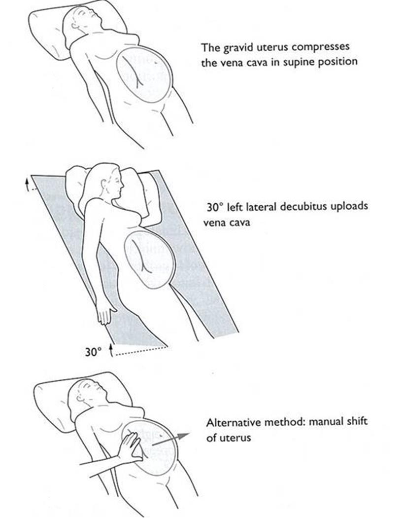 Manual Displacement Of Uterus